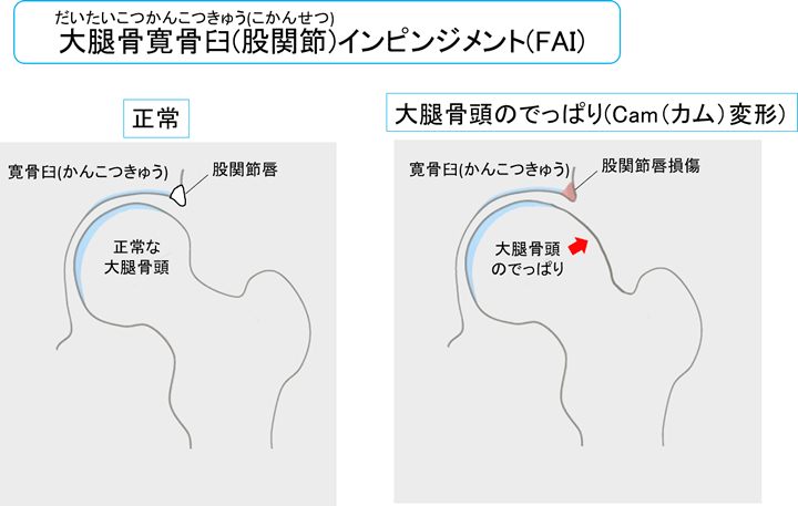 股関節唇裂傷はどのように治療されますか?